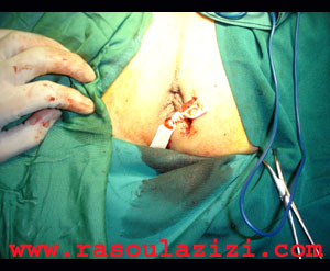 انجام عمل جراحي براي درمان فيستول مقعدي